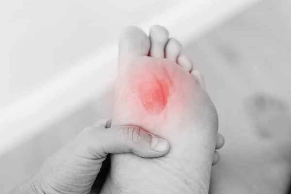Close up black white photo of woman\'s foot sole with painful callus with red point. Female is suffering from pain due to corn on leg.The problem is due to tight shoes. Healthcare and medicine concept.