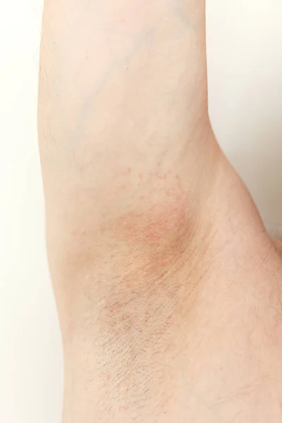 Αλλεργία Στον Βραχίονα Καλλιεργημένη Φωτογραφία Ερεθισμού Φλεγμονής Στο Ευαίσθητο Δέρμα — Φωτογραφία Αρχείου