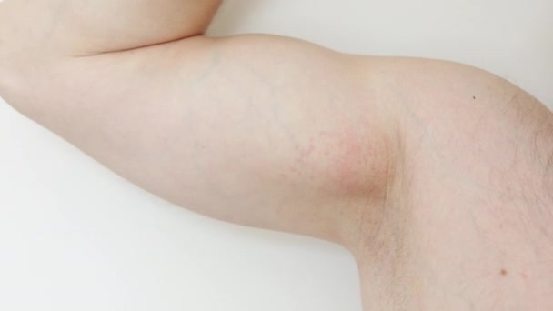Armpit Rash Acne Red Spots Unrecognisable Man Scratches Irritation Hand — Stock Video