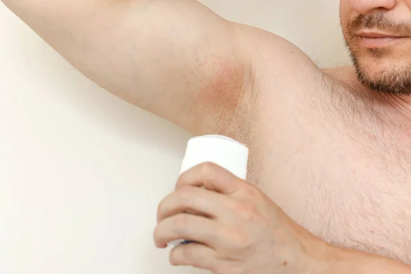Beskuren Bild Irritation Inflammation Känslig Underarmshud Efter Användning Giftig Deodorant — Stockfoto