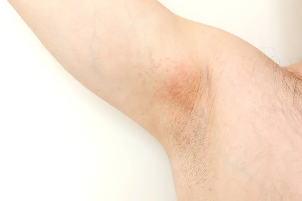 Alergia Nas Axilas Foto Cortada Irritação Inflamação Pele Sensível Após — Fotografia de Stock