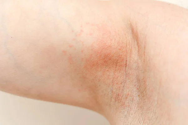 Allergy underarm. Cropped photo of irritation, inflammation on the sensitive skin after using a razor, trimmer, toxic deodorant or antiperspirant. Armpit rash. Atopic dermatitis. Acne or red spots