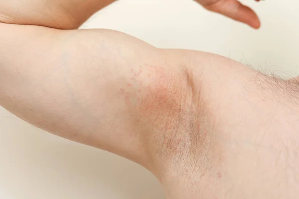 Alergia Nas Axilas Foto Cortada Irritação Inflamação Pele Sensível Após — Fotografia de Stock