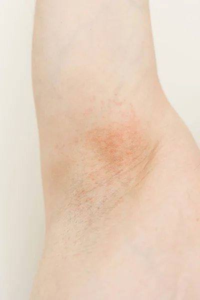 Sotto Ascelle Allergiche Foto Ritagliata Irritazione Infiammazione Sulla Pelle Sensibile — Foto Stock