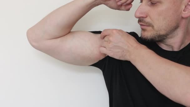 Armpit Allergy Young Man Shows Scratches Irritation Hand Sensitive Skin — Stock Video