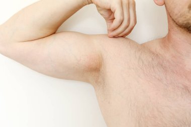 Koltuk altı alerjisi. Kesilmiş tahriş fotoğrafı, traş makinesi, zehirli deodorant ya da terleme önleyici kullandıktan sonra hassas ciltte iltihap. Koltukaltı kızarıklığı. Deri iltihabı. Sivilce ya da kırmızı noktalar