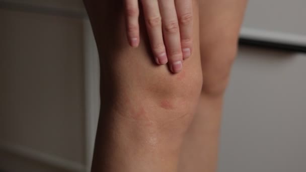 Allergic Rash Dermatitis Eczema Woman Leg Female Runs Hand Knee — Stock Video