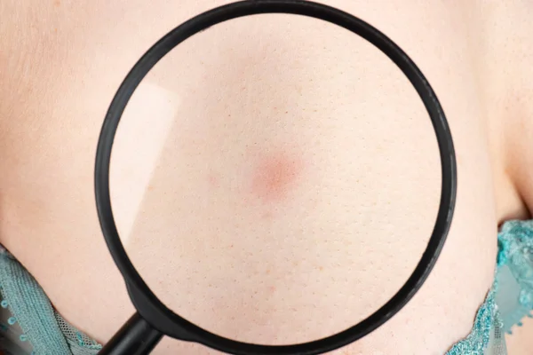 女性の乳房に赤い斑点があり乳がんの診察が終わります — ストック写真