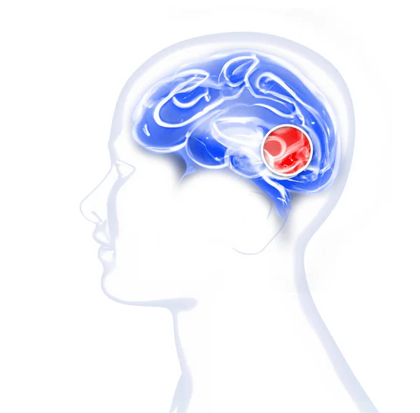 Pain Head Brain Synapses Cognitive Problems Mental Deficit Aneurysm Degenerative — Stock Photo, Image