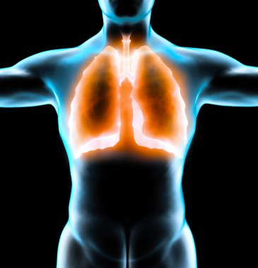 İnsan anatomisi, solunum sisteminde sorunlar, ciddi derecede zarar görmüş akciğerler. Çift taraflı zatürree. Covid-19, koronavirüs. Sabır ve sigara. Sigara içen. 3d oluşturma