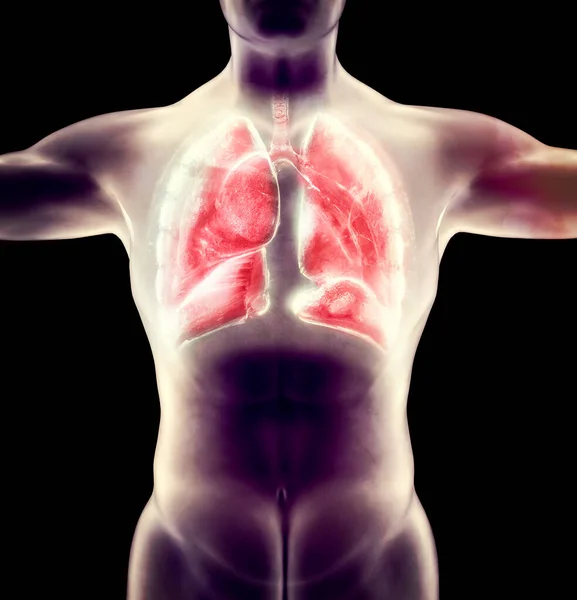 Die Menschliche Anatomie Probleme Mit Den Atemwegen Stark Geschädigte Lungen — Stockfoto