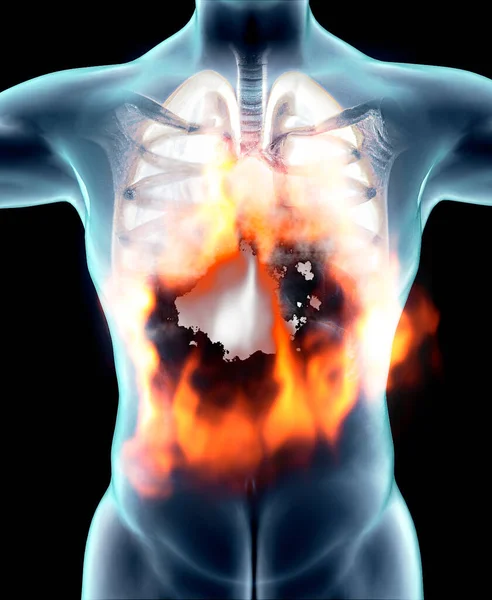 人間の解剖学 呼吸器系の問題 重度の損傷を受けた肺 二国間肺炎 Covid コロナウイルス 患者と煙 喫煙者だ 火と火だ 3Dレンダリング — ストック写真