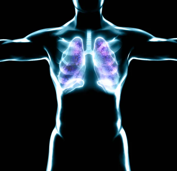 Lidská Anatomie Problémy Dýchacím Systémem Těžce Poškozené Plíce Dvoustranná Pneumonie — Stock fotografie