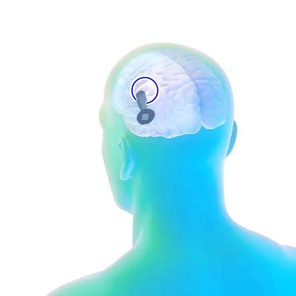 인간의 수있는 새로운 인공지능 기술입니다 사람의 두개골에 준비가 Neuralink 센서입니다 — 스톡 사진
