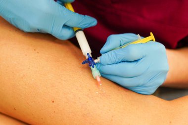 Bacaklardaki varisli damarların çıkarılması. Skleroterapi yapan doktor.