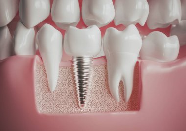 Implant next to a healthy molar -- 3D rendering clipart