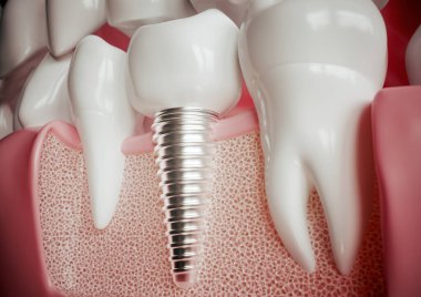 Implant next to a healthy molar -- 3D rendering clipart