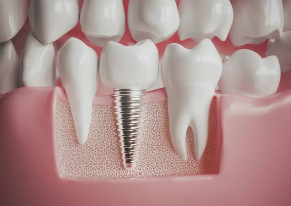 在健康的磨牙旁边植入3D渲染 图库图片