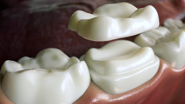 Coroa Cerâmica Sobreposição Sobre Uma Renderização Dentes — Fotografia de Stock