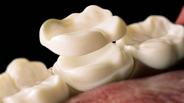 歯の上のセラミックオーバーレイクラウン 3Dレンダリング ストック画像