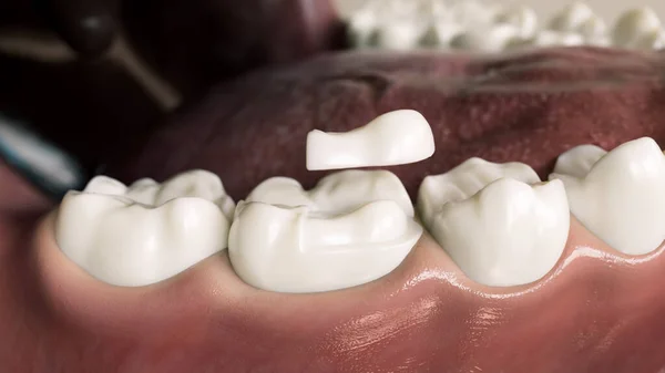 3Dレンダリング 歯の上にセラミックのみ4分の1クラウン — ストック写真