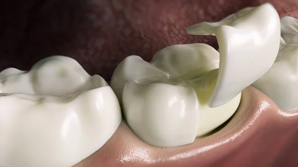 3Dレンダリング 歯の上にセラミックのみ4分の1クラウン ロイヤリティフリーのストック画像