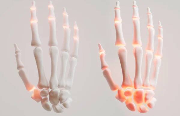Artritis Reumatoide Poliartrosis Dedos Comparación Con Renderización — Foto de Stock
