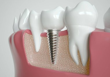 İki sağlıklı diş arasına yerleştirilmiş diş implantı, çene boyunca bir kesit içinde tasvir edilir.