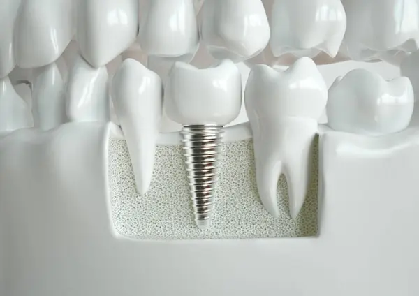 İki sağlıklı diş arasına yerleştirilmiş diş implantı, çene boyunca bir kesit içinde tasvir edilir.