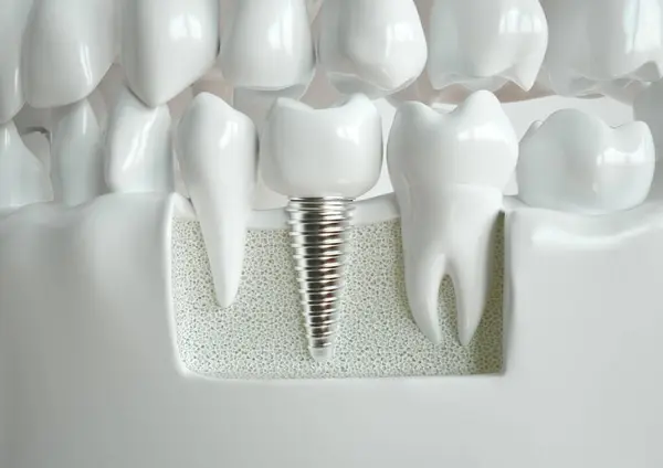 2つの健康な歯の間に挟まれた歯科インプラントは 顎を通って交差点に描かれています ロイヤリティフリーのストック写真