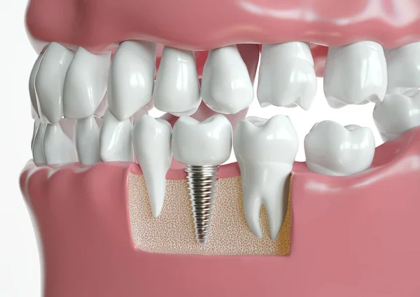 2つの健康な歯の間に挟まれた歯科インプラントは 顎を通って交差点に描かれています ストック画像