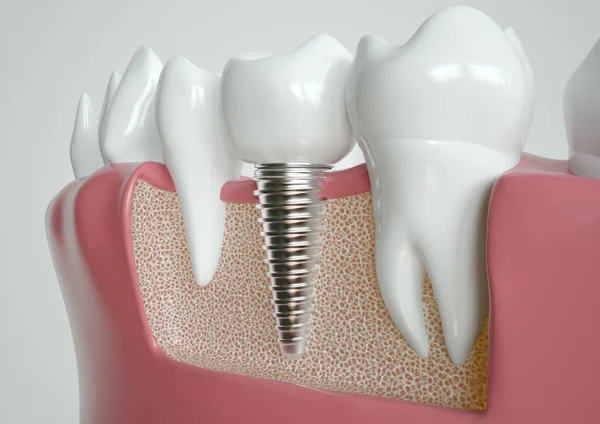牙种植体 位于两颗健康的牙齿之间 通过下巴横断面表现出来 免版税图库图片