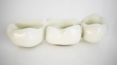 Diş implantı: Modern dişçilik ve hassasiyetin bir karışımı. Eksik dişler için dayanıklı bir çözüm, fonksiyon ve temyiz için çene ile pürüzsüz birleştirme.