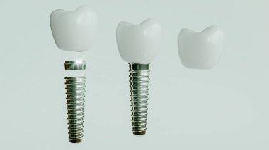 Bu 3D görüntüleme diş implantlarının montaj aşamalarını gösteriyor, implant vidasını ve bağlı olan tacı gösteriyor.