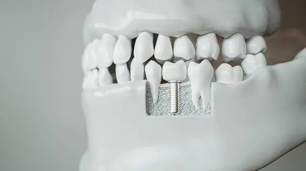 Bu üç boyutlu çizim, çene kemiğine yerleştirilmiş bir diş implantı gösteriyor.