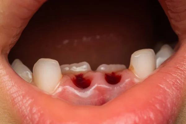 child mouth after deciduous teeth extraction