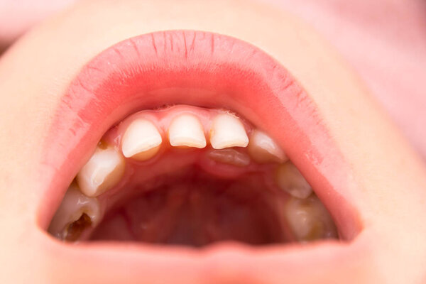 close-up photo of a tooth with caries