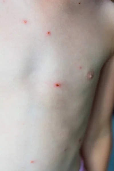 close-up photo of a child with chicken pox