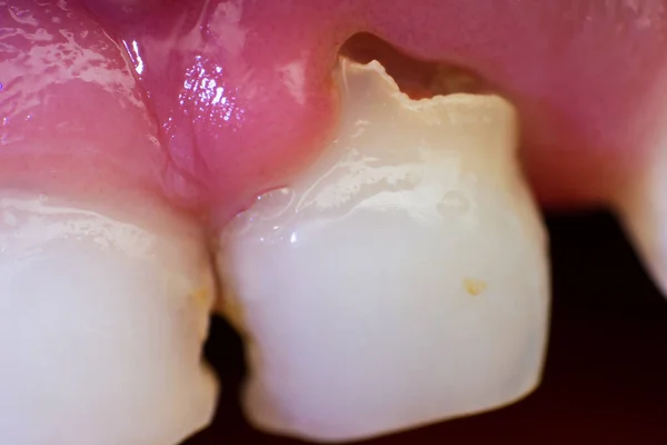 7歳の子供が骨折した乳歯のクローズアップ写真です — ストック写真
