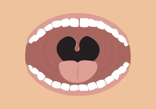 张嘴的概念与扁桃体显示 可编辑剪贴画 — 图库矢量图片