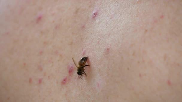 Medová Včela Bodla Muže Když Včela Pokousaná Zanechá Jedovatý Vak — Stock video