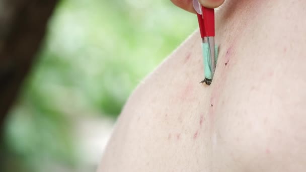 도움으로 사람의 피부에 일부러 치료를 뱉는다 독으로 관절염 — 비디오
