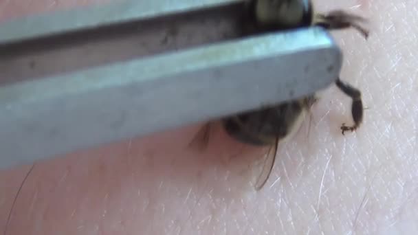 Απιθεραπεία Βοήθεια Λαβίδας Μέλισσα Τοποθετείται Στο Δέρμα Ενός Ατόμου Και — Αρχείο Βίντεο