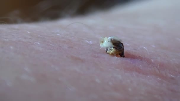 Bienengiftbeutel Honigbiene Sticht Mann Den Arm Wenn Der Stich Vorbei — Stockvideo
