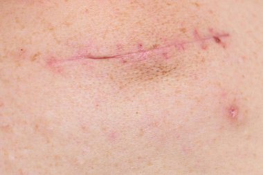 Dikişleri çıkardıktan sonra iyileşme yarasının detaylarıyla yaşlı bir adamın derisinin bir parçası.