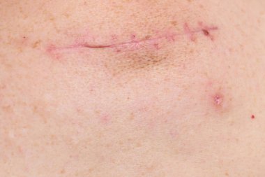 Dikişleri çıkardıktan sonra iyileşme yarasının detaylarıyla yaşlı bir adamın derisinin bir parçası.