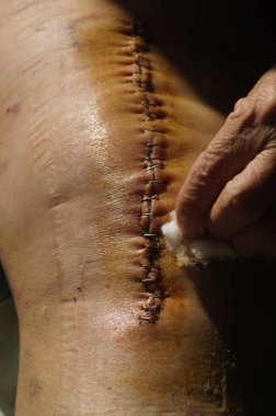 Dizdeki cerrahi dikiş. İyileşmek için özel metal dikişle dikilmiş cerrahi yara. Tam bir diz eklemi değişimi. Yakın plan..