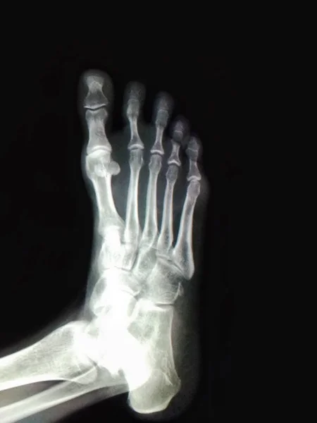 Xray of a healthy right foot of a 47 year old human female from above view with the leg lying to the left