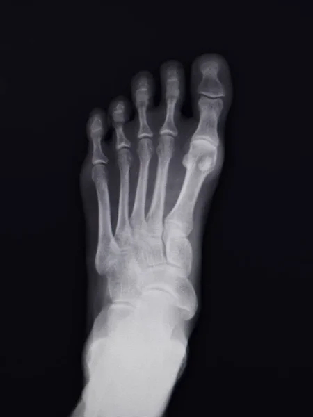 X-ray of the right foot of an adult woman in overhead and subjective view.
