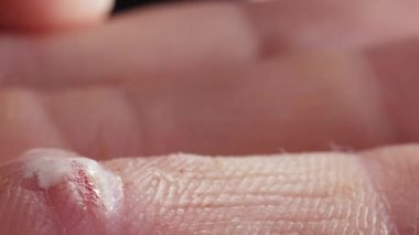 Parmağındaki yaranın tedavisi için hidrojen peroksit kullanıldı. makro